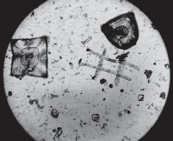Картина кристаллизации мочи крыс при заражении T. spiralis в дозе 500 личинок (× 60)
